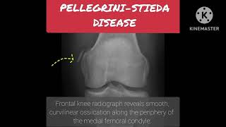 Pellegrini Stieda disease [upl. by Fleisher]