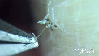 pLuCkInG Ingrown Hair in Satisfying Compilation [upl. by Atikahc]