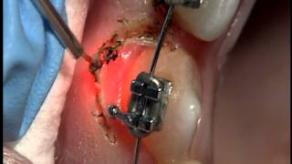 AMD Laser  Gingivectomy around brackets with Picasso [upl. by Aliab]