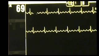 Atrial Flutter  ACLS Rhythm Recognition and Guidelines [upl. by Asiela]