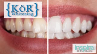 SUPER EFFECTIVE Teeth Whitening Solution  Kör Whitening [upl. by Rahcir]