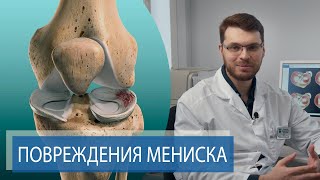 ТРАВМА МЕНИСКА  Боль и хруст в колене [upl. by Adnauqal]