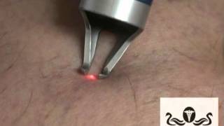 Laser Therapy Treatment for Spider Veins at Wisconsin Vein Center amp MediSpa [upl. by Kipton]