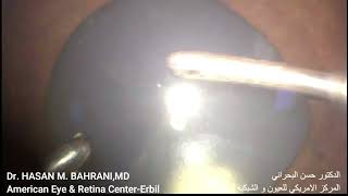 Anterior Chamber Silicon oil removal iridectomy [upl. by Adelice481]