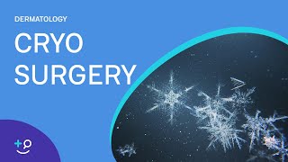 Cryo Surgery Procedure Freezing [upl. by Mchale]