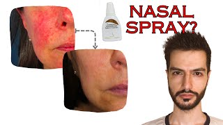 Rosacea Redness treatment with a Nasal Spray  Mo React [upl. by Sedda]