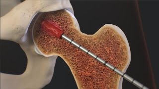 IntraOsseous BioPlasty® IOBP Surgical Technique for a Bone Marrow Lesion of the Hip [upl. by Indira]