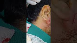 Incision and drainge of absces inferior to rt ear lobule entdoctor [upl. by Iamhaj836]