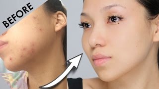 Remove Acne Marks  3 Home Remedies 100 Works With Results [upl. by Aiuoqes591]