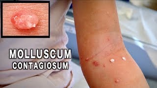 UNUSUAL MOLLUSCUM CONTAGIOSUM Treated with Cryotherapy  Dr Paul [upl. by Mathur326]