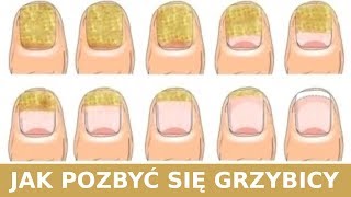 Jak Pozbyć Się Grzybicy Szybko i Naturalnie [upl. by Anikehs]