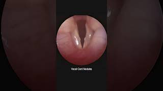 Pediatric Vocal Cord Nodules Development and Resolution Time Lapse [upl. by Tavia284]