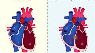 USMLE Aortic valve regurgitation  valvular heart disease USMLE step 1 easy [upl. by Norita]