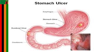 peptic Ulcerspathophysiology [upl. by Nivets665]