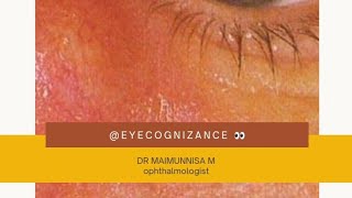 What is Dacryocystitis eyecognizance [upl. by Sherman796]