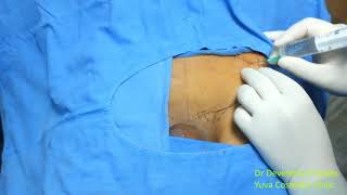 Iliohypogastric amp Ilioinguinal Nerve Block [upl. by Marijo]