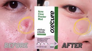 EFFECTIVE SA PIMPLES TO ONLY P8900  OXECURE Acne Clear Powder Mud [upl. by Jacquette]