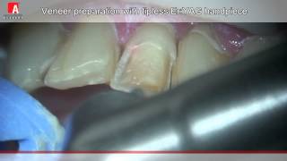 VENEER PREPARATION AND ROOT CANAL OPENING Fotona Lightwalker ErYAG laser [upl. by Sussman]