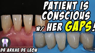 Closing The Patients Gaps with Direct Composite Technique C24 [upl. by Marou]