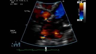 Atrial Septal Defect  Ostium Secundum Type  TTE [upl. by Steven]