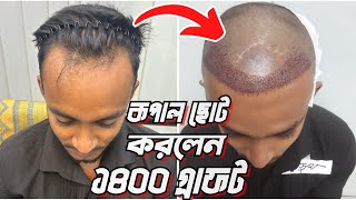 ১৪০০ গ্রাফট এ নতুন হেয়ার লাইন সার্জারি  Hair Transplant Bangladesh hairtransplantbangladesh [upl. by Notgnirrac]