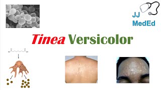 “Fungal Skin Infection of Many Colors” Tinea Versicolor  Pathogenesis Symptoms and Treatment [upl. by Milt]