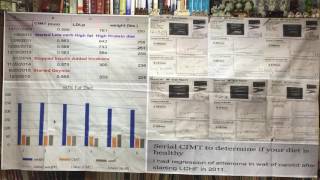 Proof of regression of plaque after 7 years on Atkins diet [upl. by Enylecoj]