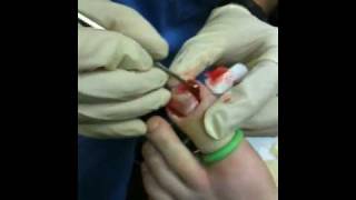 Performing an Ingrown toenail surgery with cauterization of granuloma Day 1 [upl. by Annaihr]