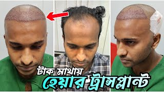 গাজীপুর থেকে এসে টাক মাথায় হেয়ার ট্রান্সপ্লান্ট  টাক মাথার সমাধান  Hair Transplant Bangladesh [upl. by Hak356]