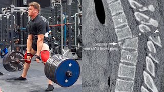 504 KG Deadlift Broke His Spine [upl. by Irrok]