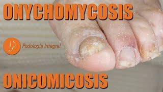 Onychomycosis  Toenail cleaning podology asmr [upl. by Melly]