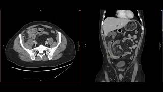 Abdominal Imaging Call Prep Cases Perforated Appendicitis CT Case 3 Discussion [upl. by Cary188]