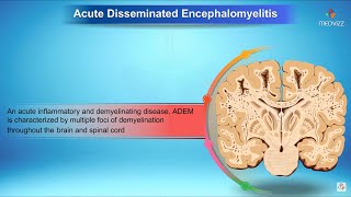 Acute disseminated encephalomyelitis  Neurology [upl. by Jens399]