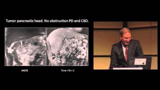 Dr J Hermans Liver and Pancreatic perfusion using Aquilion ONE Vision [upl. by Acirfa]