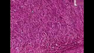 Histopathology Soft tissueFibrosarcoma [upl. by Ahsineg]