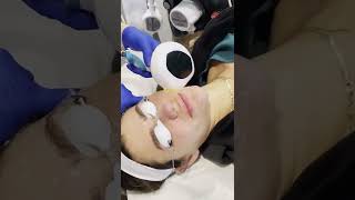 Lumecca IPL Treatment [upl. by Aelram]