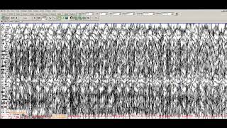 Learn to Read EEGs Part 3 [upl. by Sirret798]