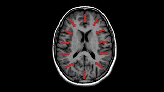 Death by Clot Ischemic Stroke [upl. by Titus343]