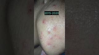 Tretinoin Cream Change My Skin  Tretinoin Cream Before amp After My Skin shorts beauty tretinoin [upl. by Rosenzweig]