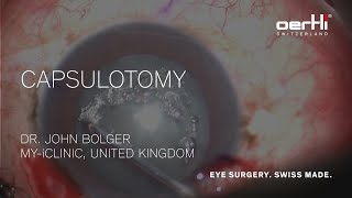 Surgery Video Capsulotomy by John Bolger [upl. by Juliette]