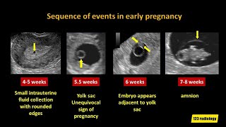 Early Pregnancy Failure A simplified Ultrasound Approach [upl. by Htiek]