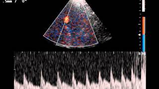 TRANSCRANIAL DOPPLER AND PARADOXICAL EMBOLISM [upl. by Edee]