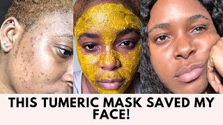 THE TUMERIC MASK THAT CLEARED MY ACNE SCARS AND HYPER PIGMENTATION [upl. by Lorie]