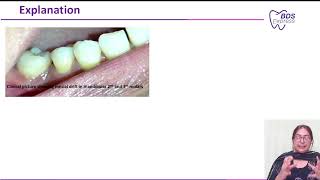 NEET MDS 2024 Ortho  Mesial drift [upl. by Dorolisa]