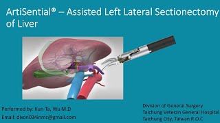 Artisential  assisted Left Lateral Sectionectomy [upl. by Eerahs978]