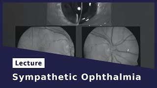 Sympathetic Ophthalmia [upl. by Park]