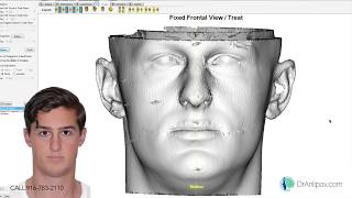 3D planning Orthognathic [upl. by Anih]