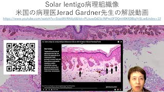 solar lentigo病理組織像の解説 [upl. by Natek68]