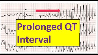 Prolonged QT interval Causes Measurements Torsades De Pointes [upl. by Nerat]