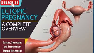 Ectopic Pregnancy Understanding the Risks Symptoms and Treatment [upl. by Lorimer]